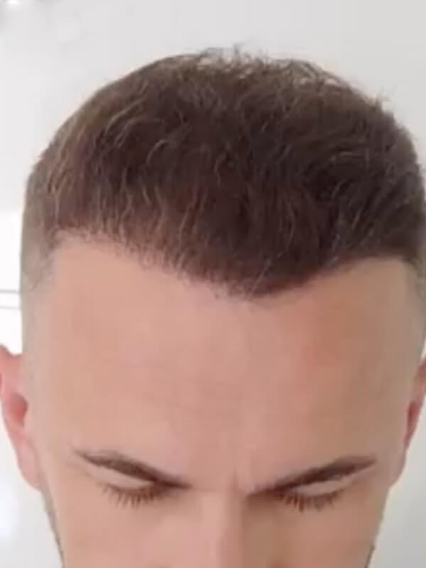 Mann zeigt seine neue Frisur nach der Haartransplantation