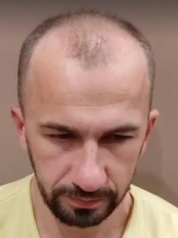 Mann vor der Haartransplantation